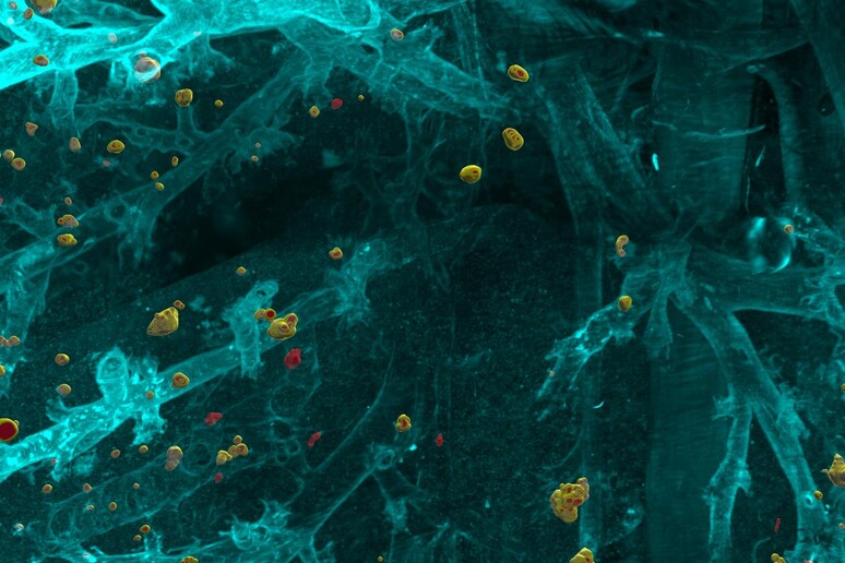 Il programma di intelligenza artificiale DeepMact riesce a individuare anche le metastasi più sfuggenti (fonte: Helmholtz Zentrum München) - RIPRODUZIONE RISERVATA